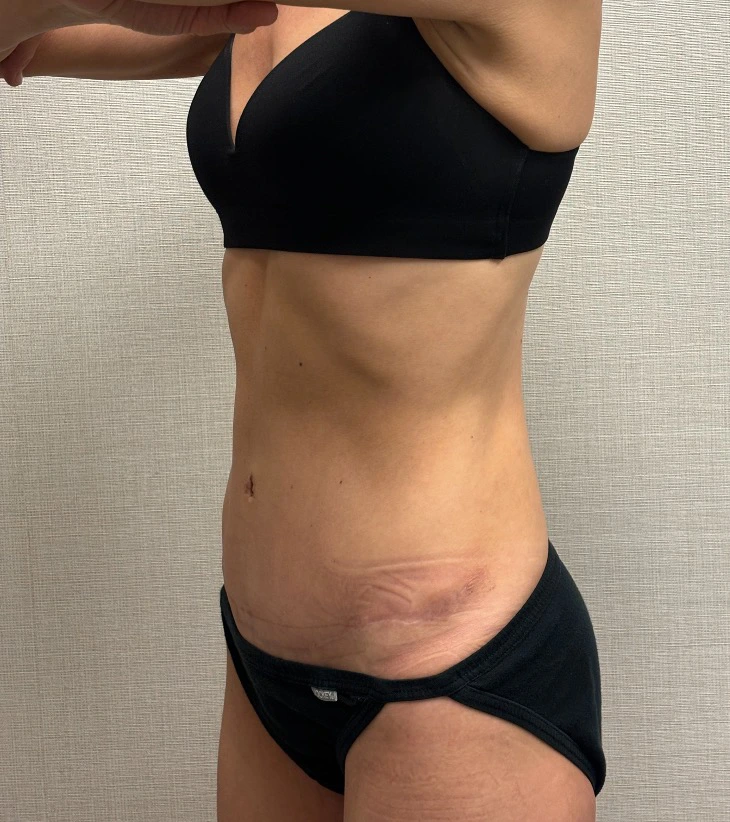 Revision-Tummy-Tuck-Case--23643 | After Body 2