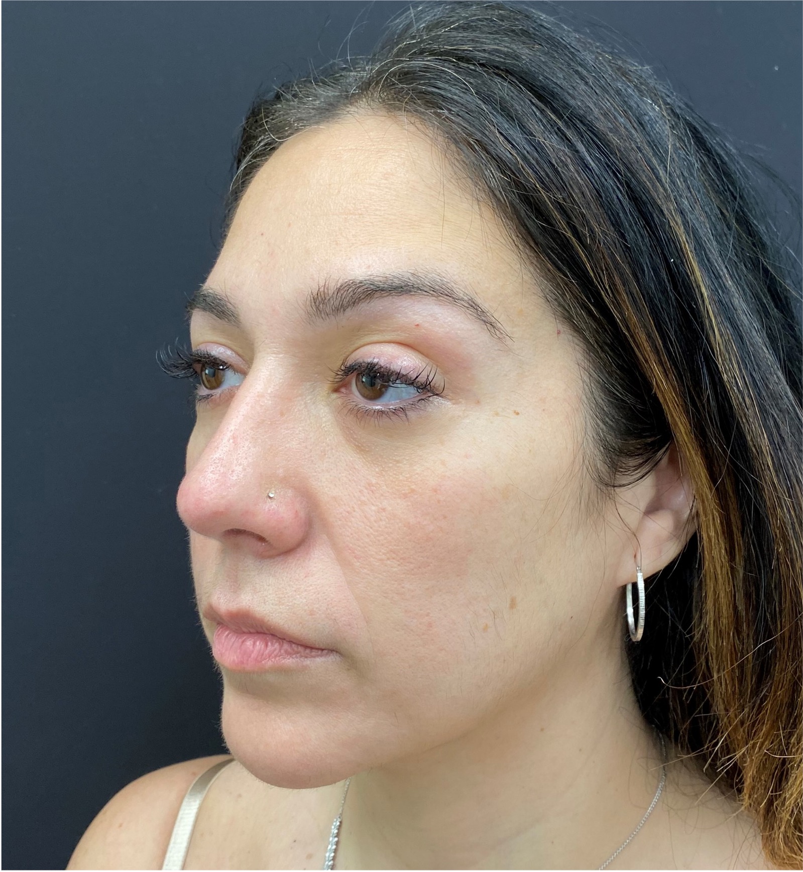Rhinoplasty-Case--377 | After Face 1