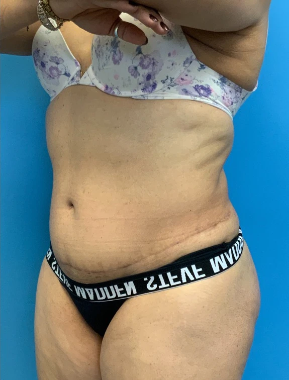 Tummy-Tuck-Case--25988 | After Body 2