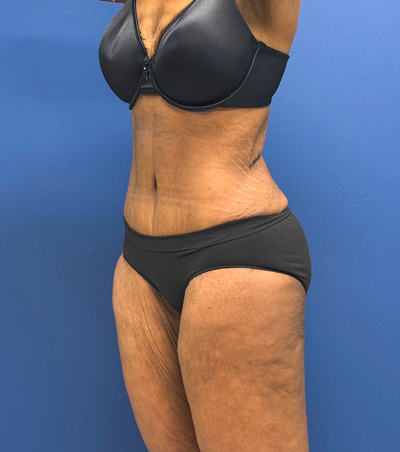 Tummy-Tuck-Case--28714 | After Tummy Tuck 2