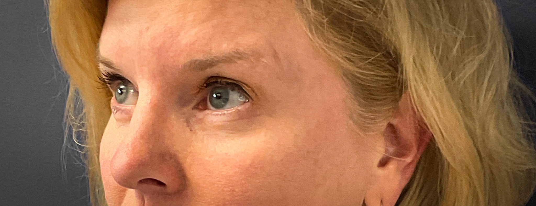 Blepharoplasty-Case--7015 | After Dr. Arjun Kanuri 2