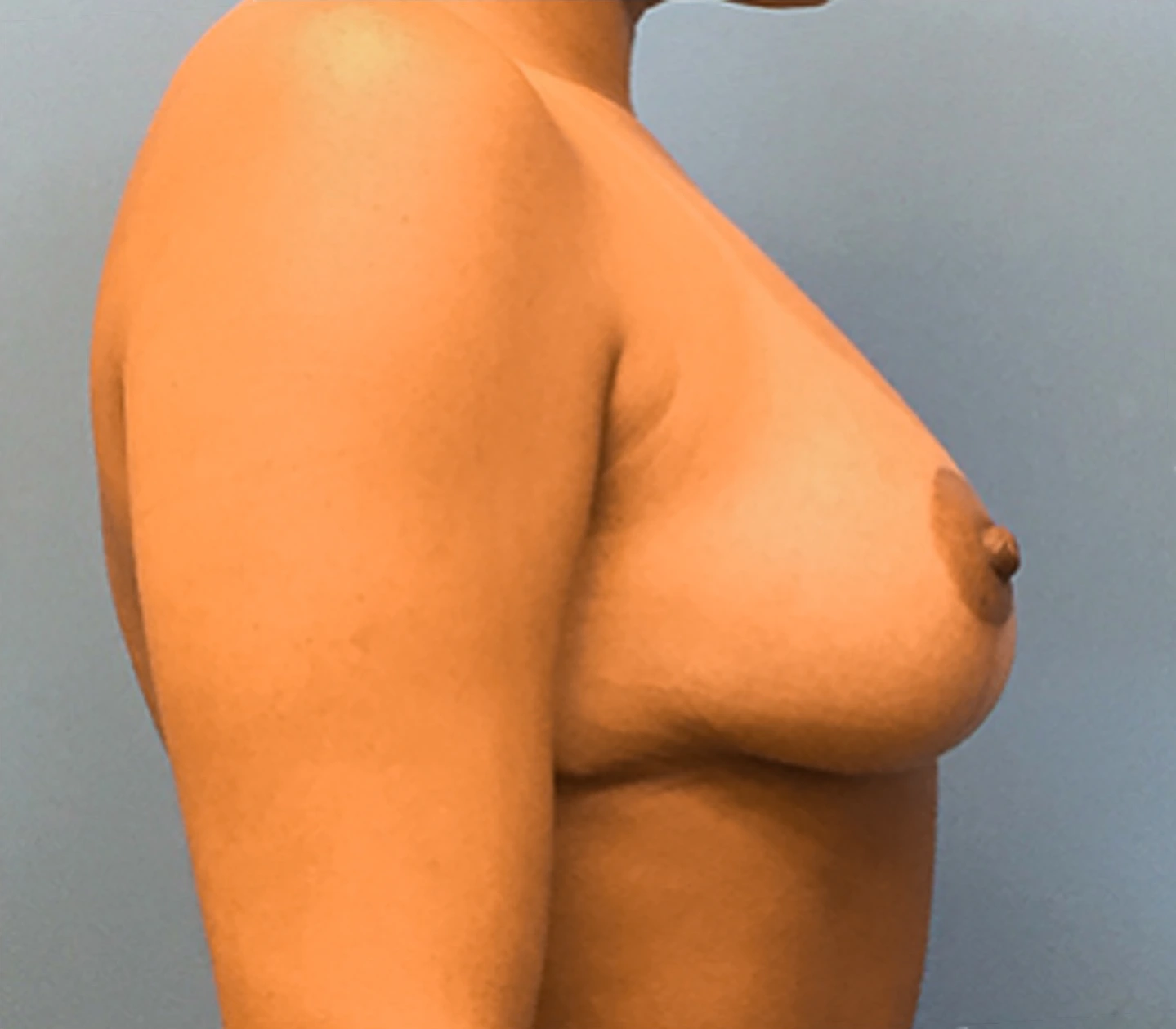 Breast-Reduction-Case--131 | After Breast Reduction 3