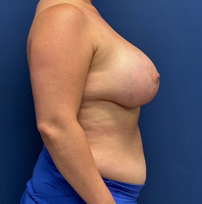Breast-Augmentation-Mastopexy-Case--29079 | After Breast Augmentation With Lift 3