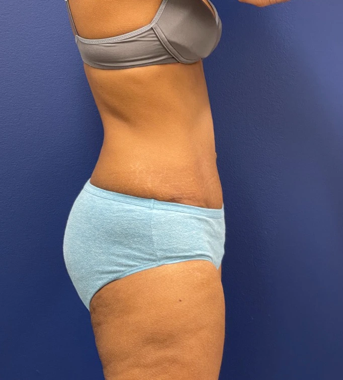 Abdominoplasty-Case--24922 | After Liposuction 3