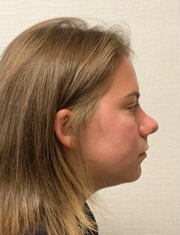 Rhinoplasty-Septoplasty-Case--23611 | After Dr. Arjun Kanuri 2