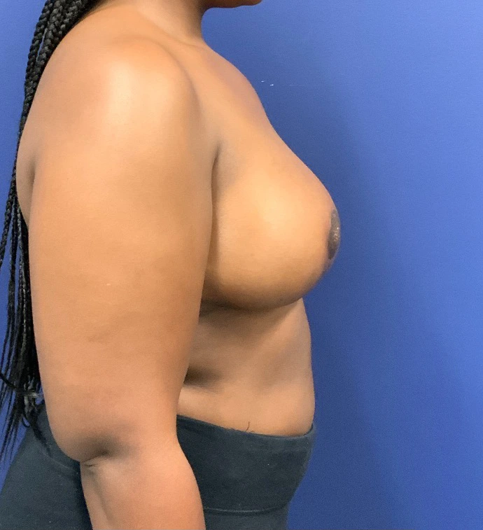 Breast-Reduction-Case--27530 | After Breast Reduction 5