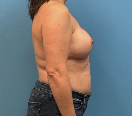 Breast-Reconstruction-Case--27065 | After Breast Reconstruction 2