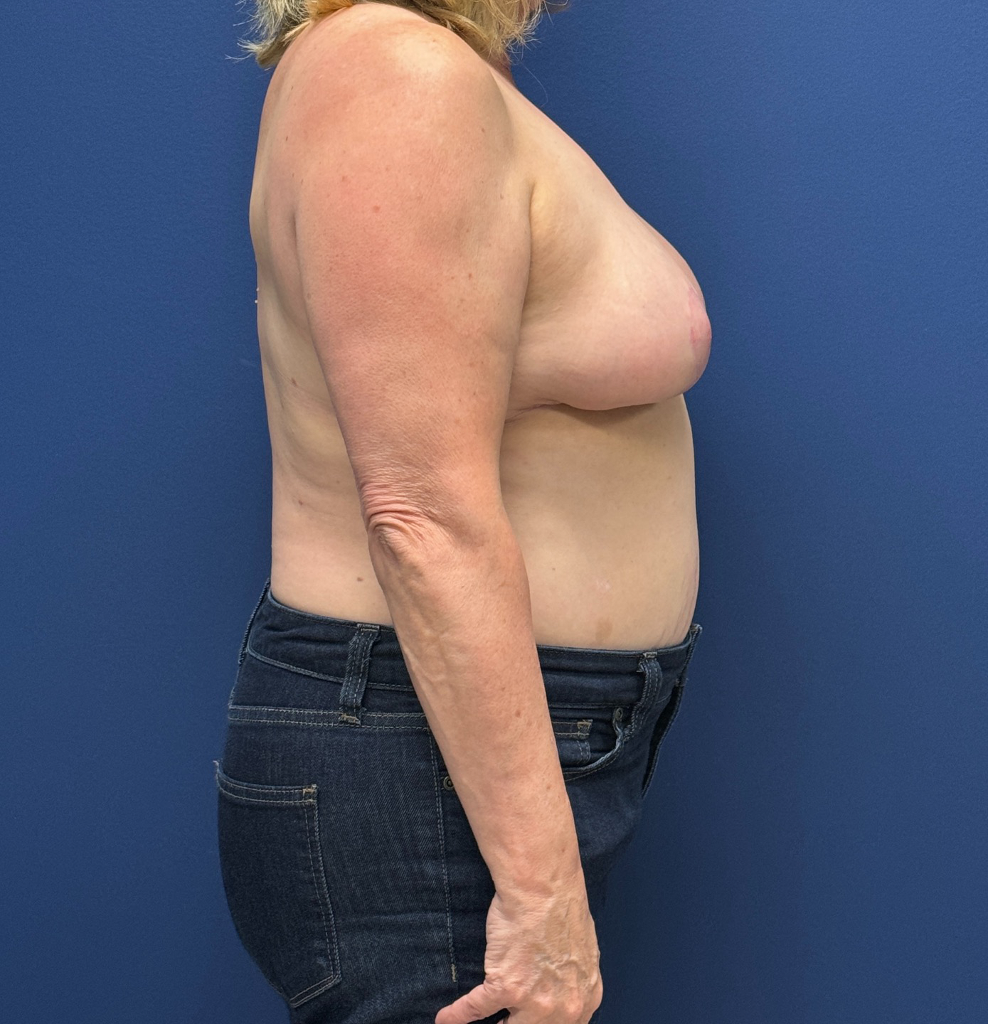 Breast-Reduction-Case--29091 | After Breast Reduction 3