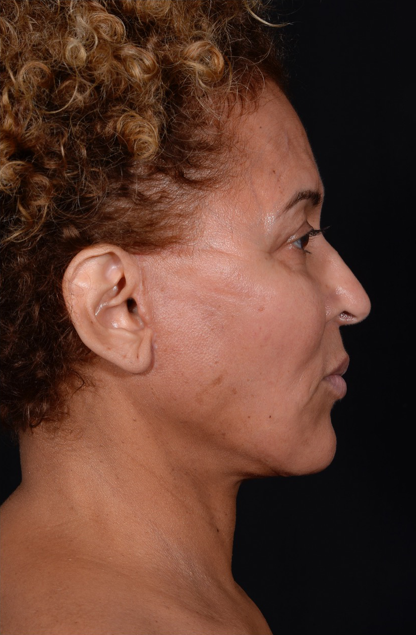 Facelift-Case--360 | After Facelift 4