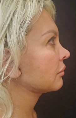 Facelift-Case--362 | After Dr. Arjun Kanuri 2