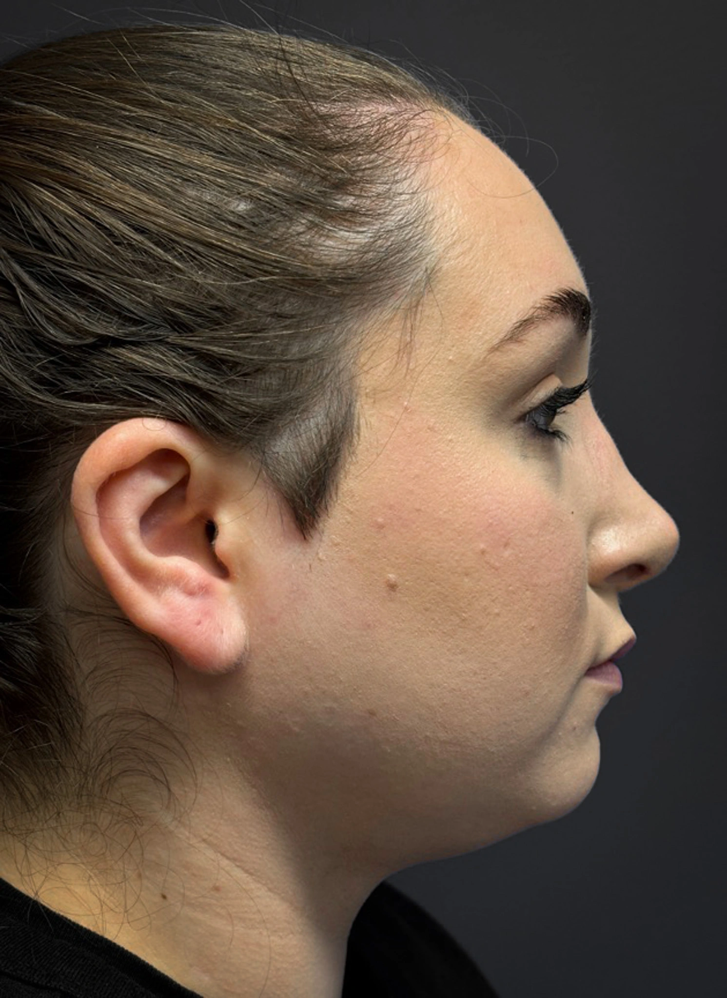 Submental-Liposuction-Case--3439 | After Face 2