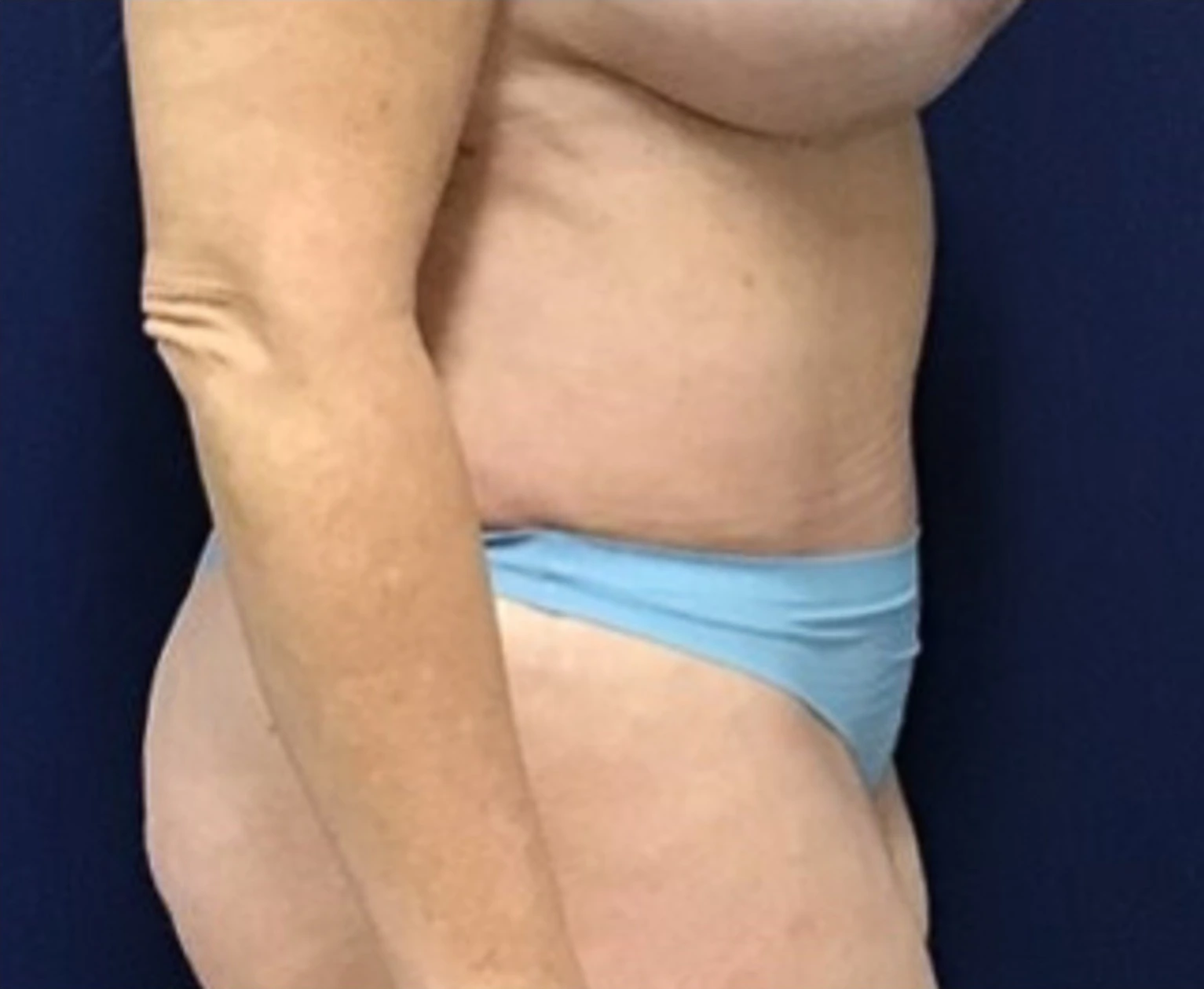Liposuction-Tummy-Tuck-Case--25682-2 | After Liposuction 5
