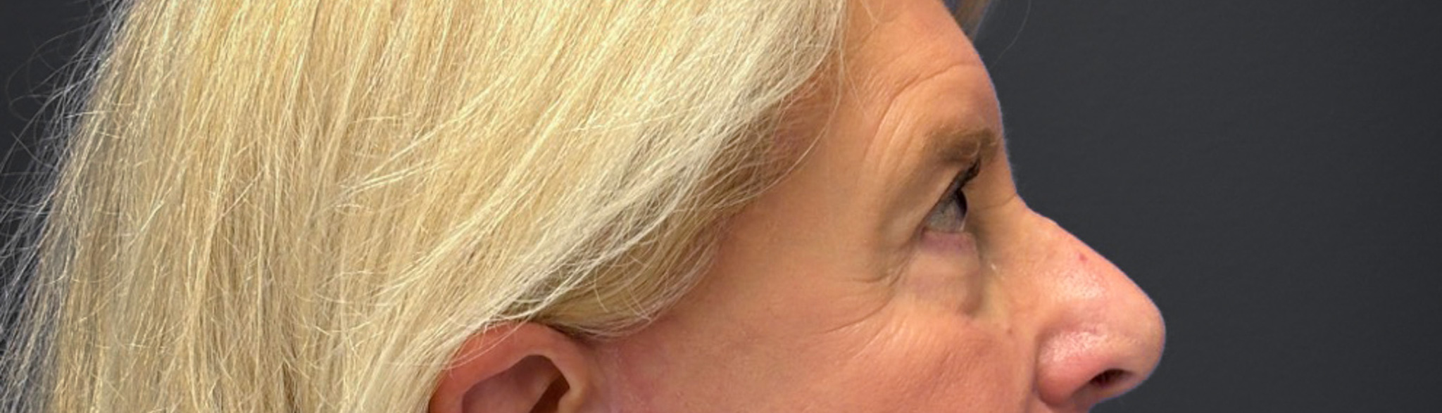 Blepharoplasty-Case--3336 | After Dr. Arjun Kanuri 2