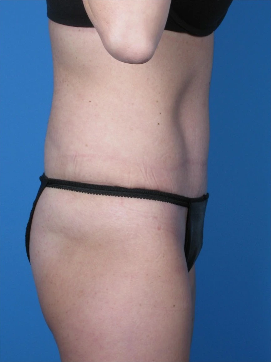 Tummy-Tuck-Case--250 | After Body 2