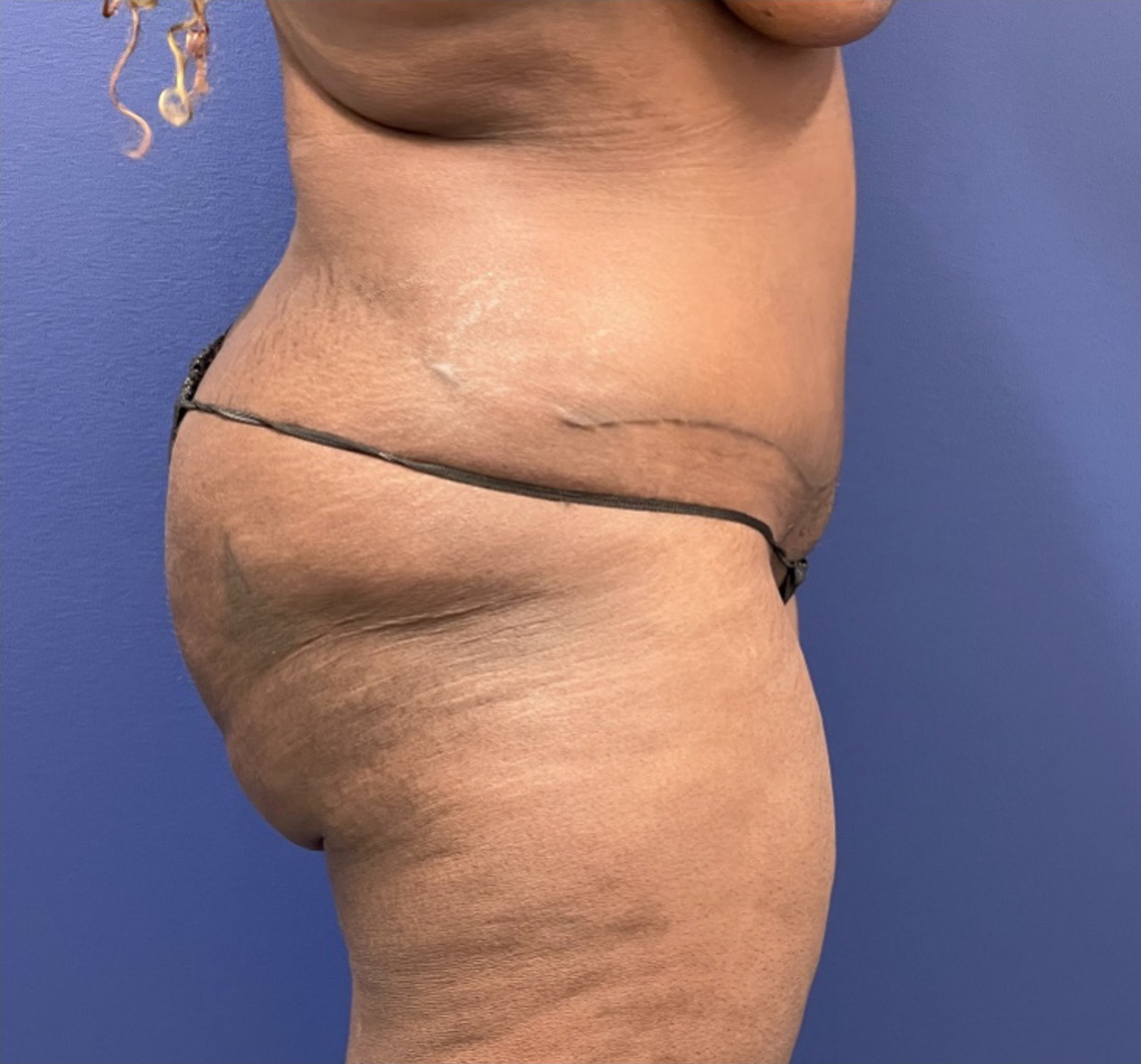 Case--257 | After Liposuction 3