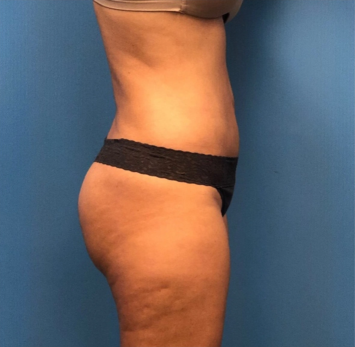 Lipo-360-Case--277 | After Body 2