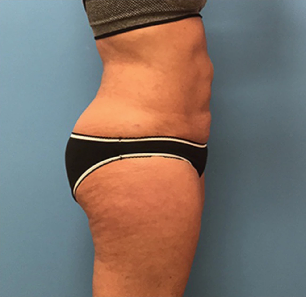 Liposuction-Case--72-1 | After Body 2
