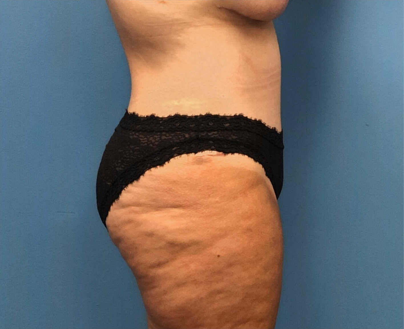 Case--252 | After Liposuction 2