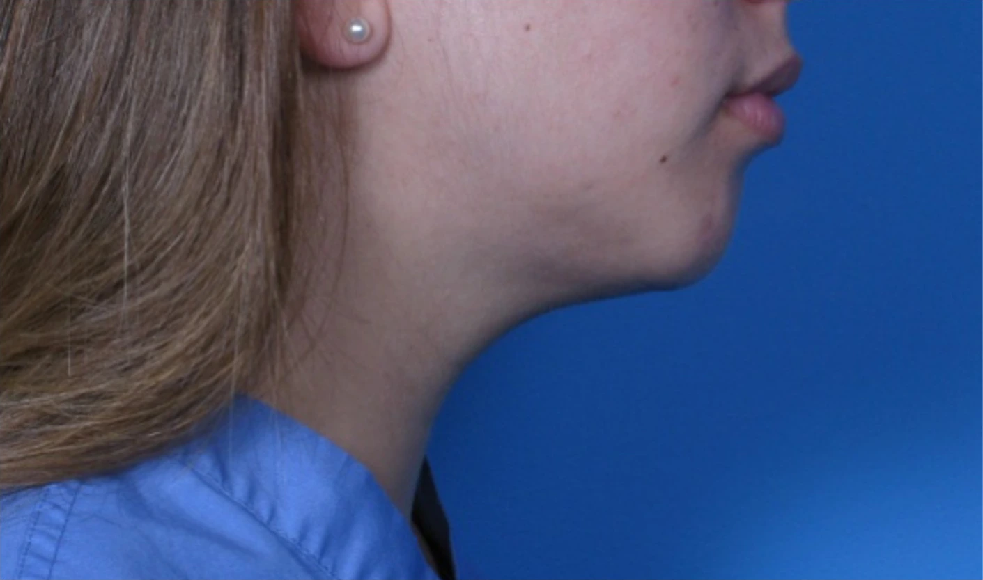 Case--293 | After Submental Liposuction 3