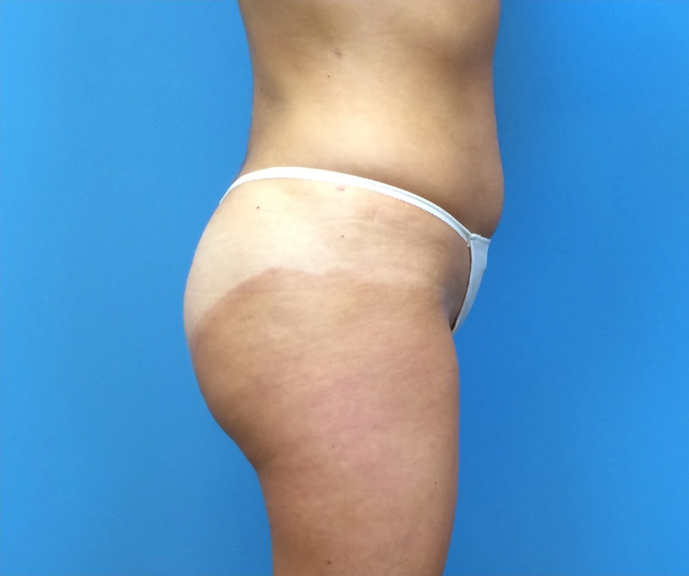 Brazilian-Butt-Lift-Case--265 | After Brazilian Butt Lift 3