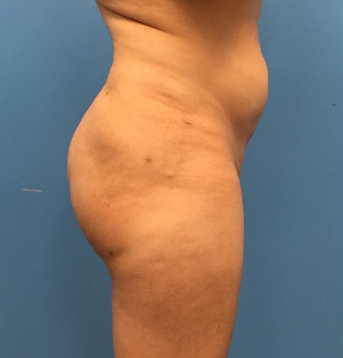 Brazilian-Butt-Lift-Case--272 | After Brazilian Butt Lift 5