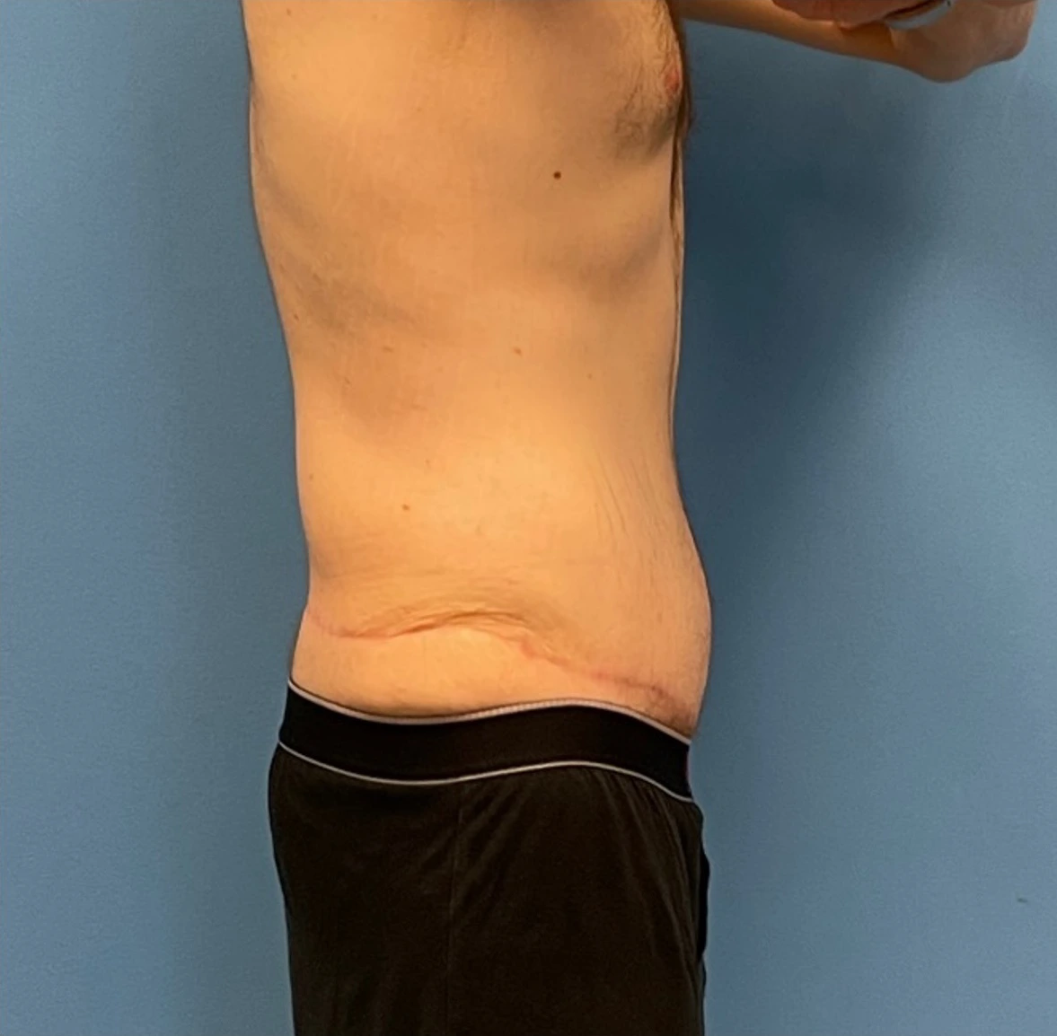 Body-Lift-Case--273 | After Dr. Samir Rao 2