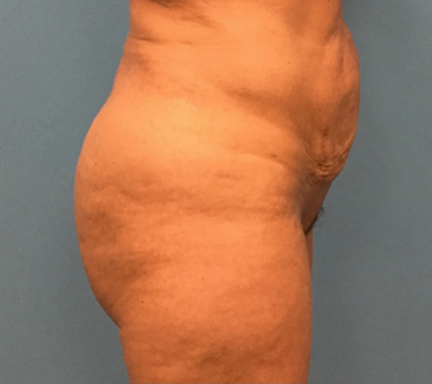 Brazilian-Butt-Lift-Case--74 | After Brazilian Butt Lift 4