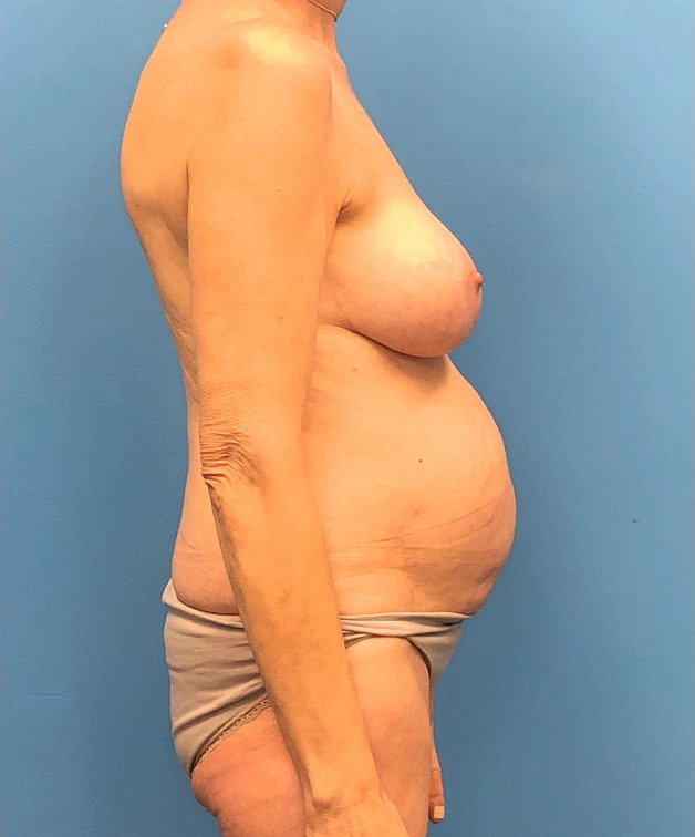 Case--17297 | Before Breast Lift 3