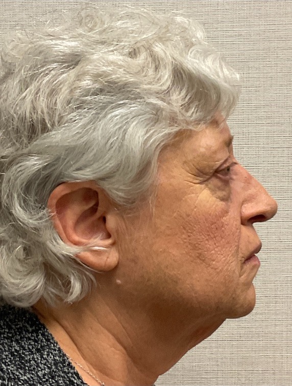 Rhinoplasty-Case--25467 | After Face 2