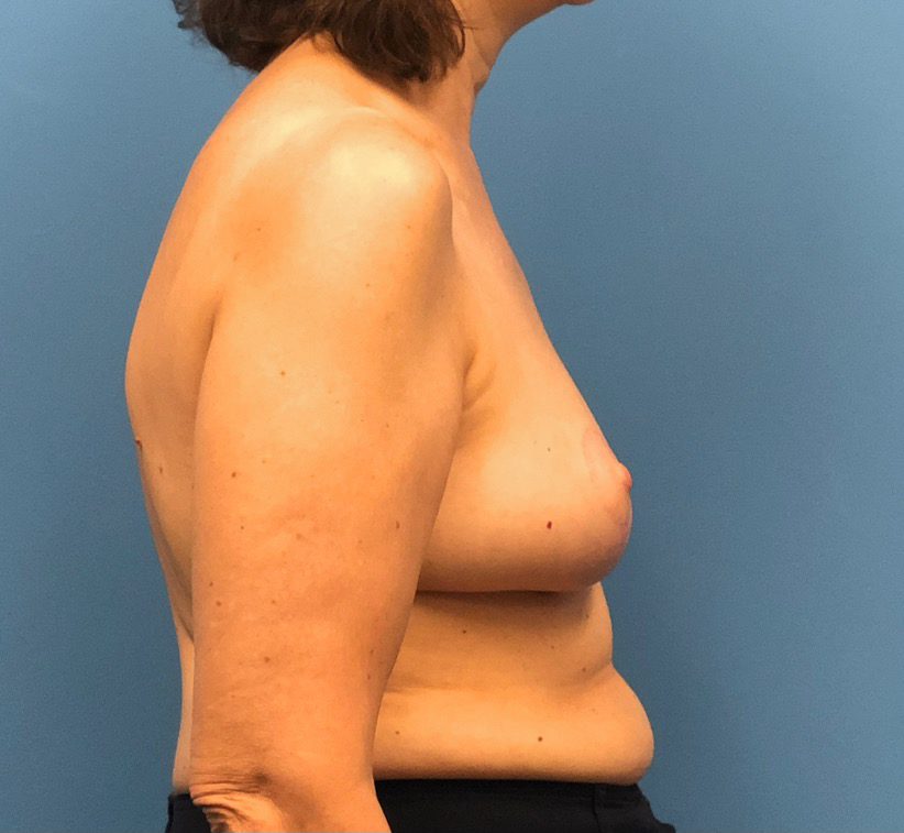 Breast-Reduction-Case--13180 | After Breast Reduction 3
