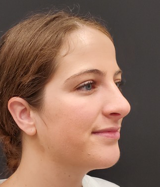 Rhinoplasty-and-Chin-Implant-Case--381 | After Dr. Arjun Kanuri 2