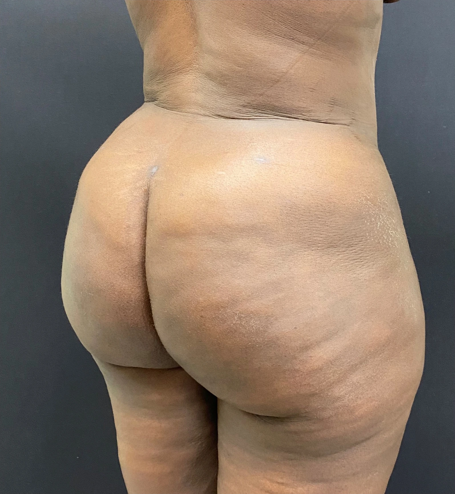 Brazilian-Butt-Lift-Case--353 | After Body 2