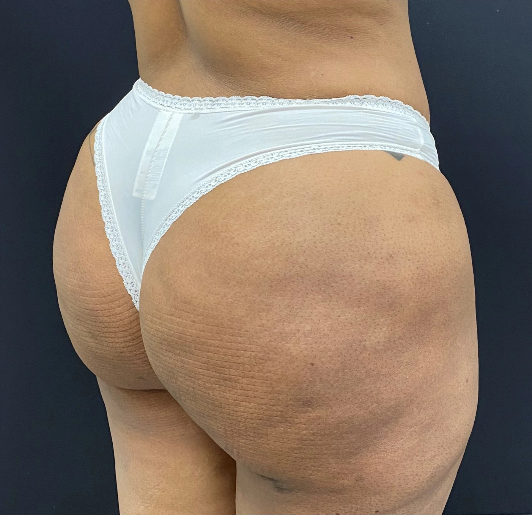 Brazilian-Butt-Lift-Case--352 | After Dr. Arjun Kanuri 2