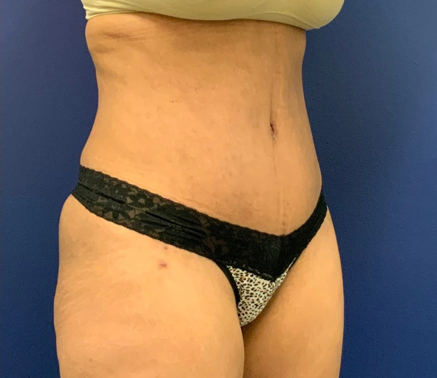 Lipoabdominoplasty-Case--21755 | After Tummy Tuck 3