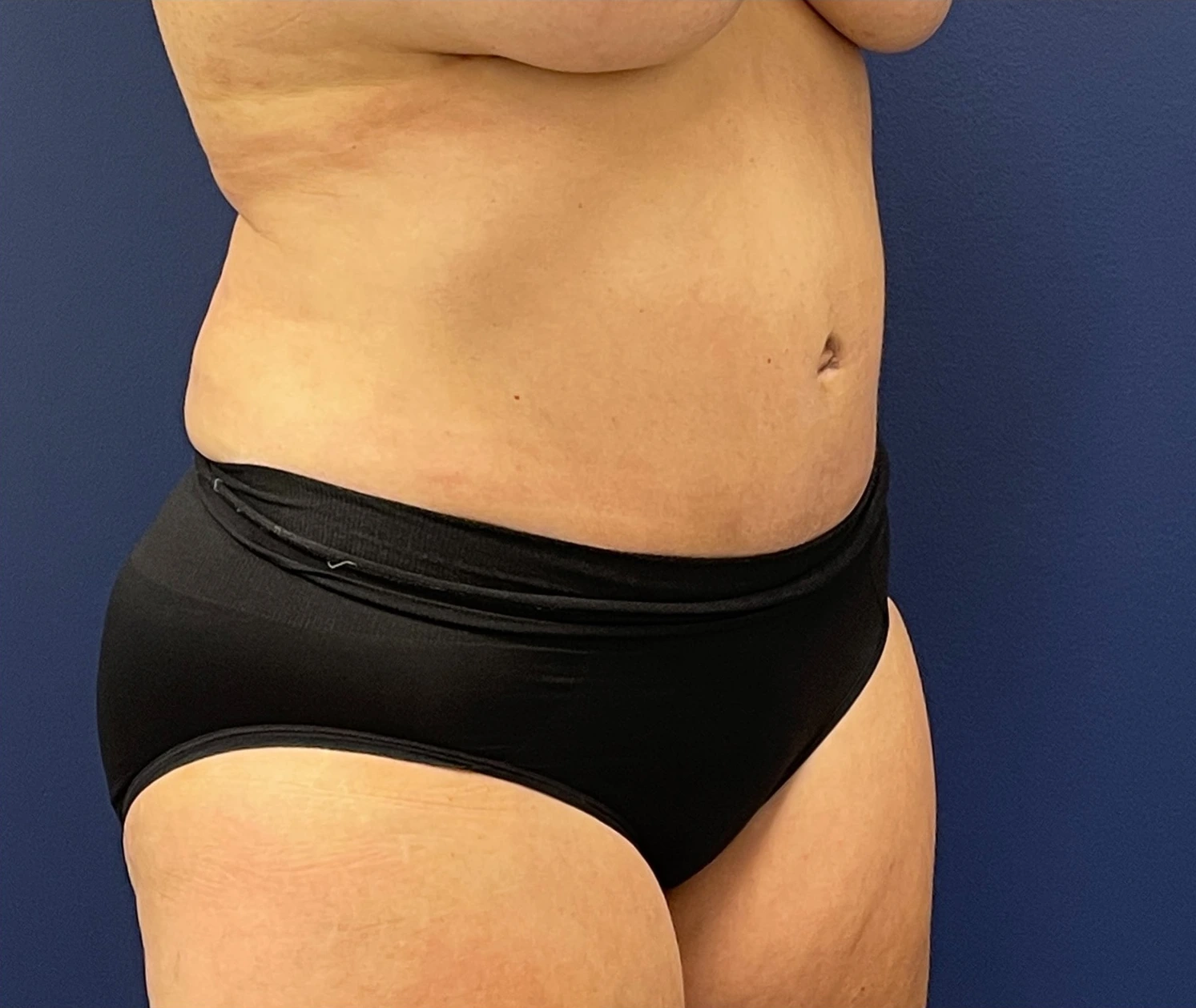 Abdominoplasty-Case--21804 | After Tummy Tuck 3