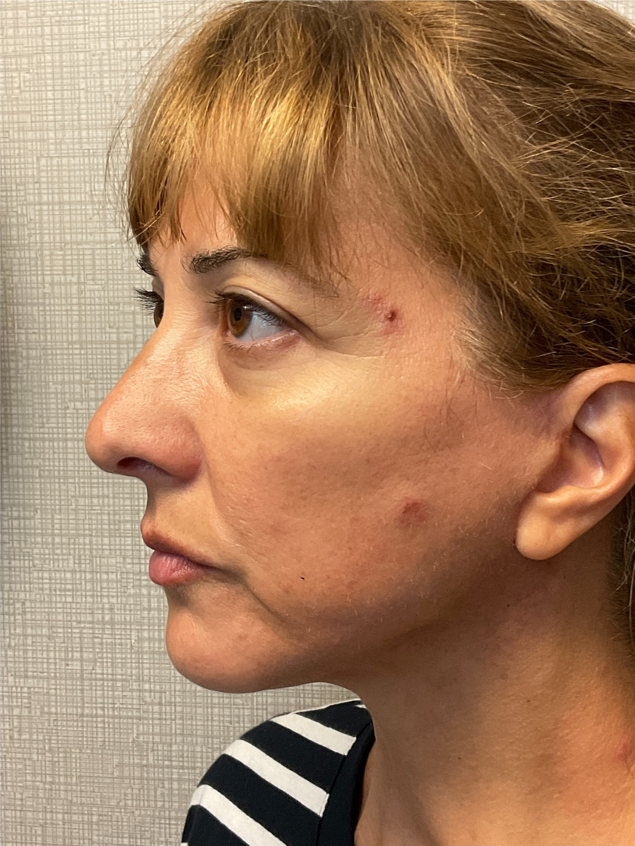 Facelift-360-Facial-Fat-Graft-Blepharoplasty-Neck-Lift-Case--6190 | After Face360 5