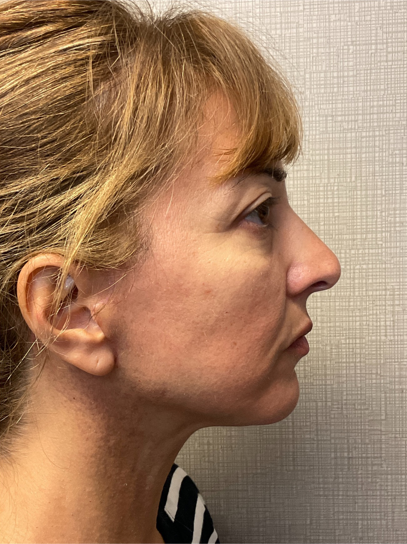 Facelift-360-Facial-Fat-Graft-Blepharoplasty-Neck-Lift-Case--6190 | After Face360 3