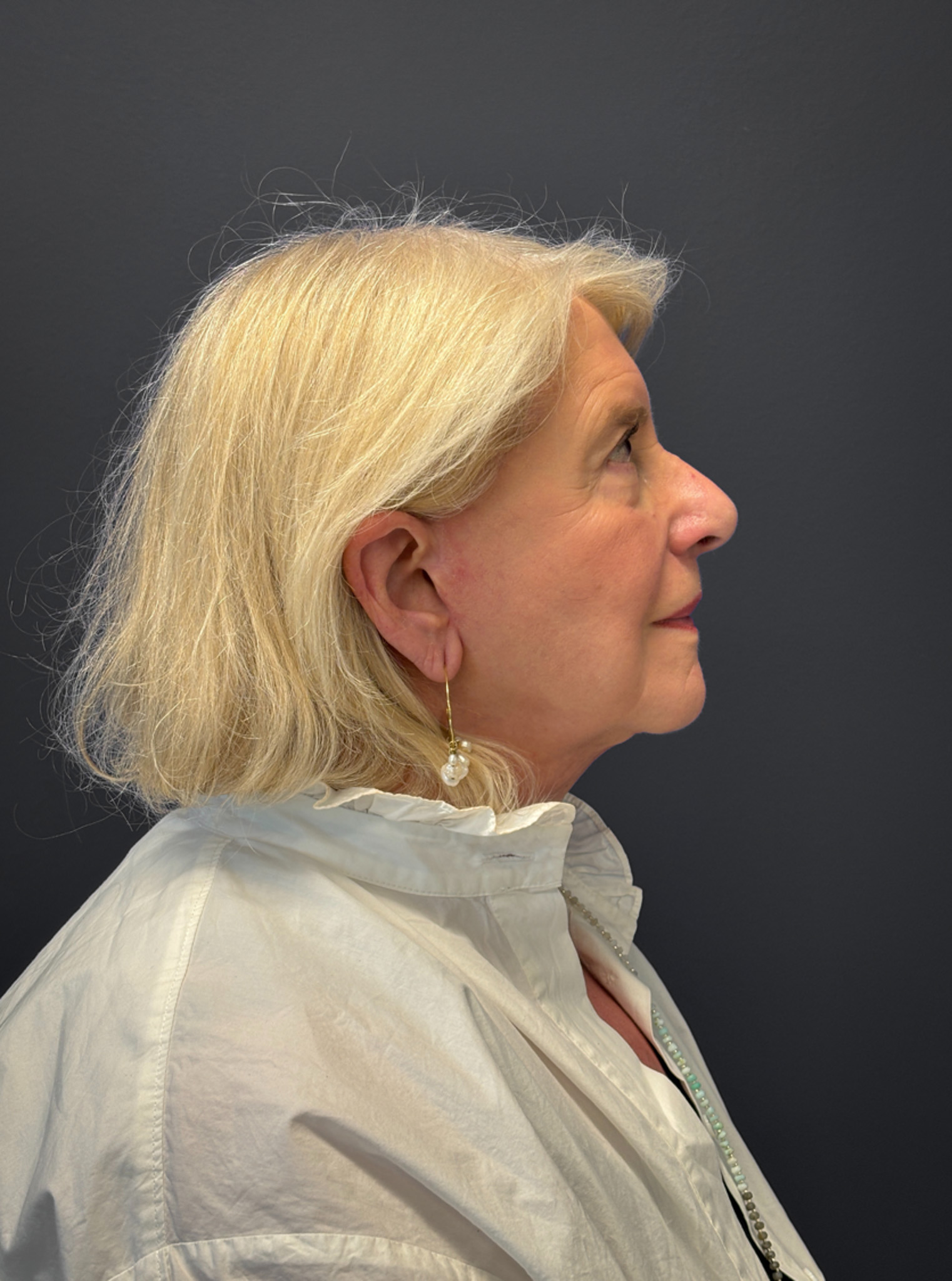 Facelift-360-Facial-Fat-Grafting-and-Necklift-Blepharoplasty-Case--1088 | After Face360 3