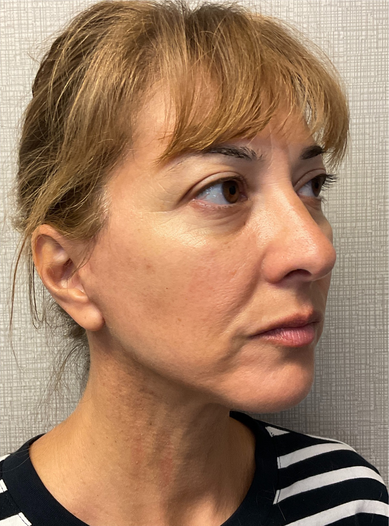 Facelift-360-Facial-Fat-Graft-Blepharoplasty-Neck-Lift-Case--6190 | After Face360 4