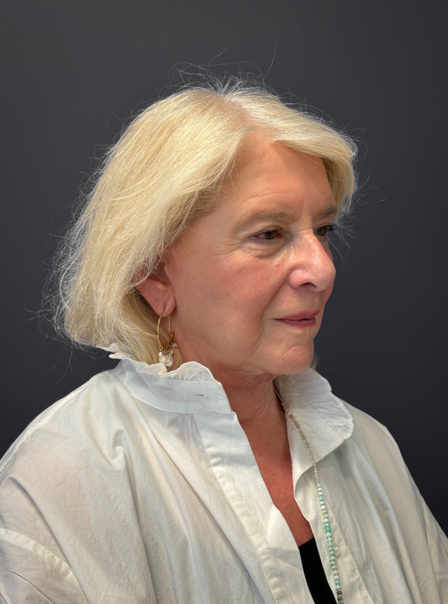 Facelift-360-Facial-Fat-Grafting-and-Necklift-Blepharoplasty-Case--1088 | After Face360 4