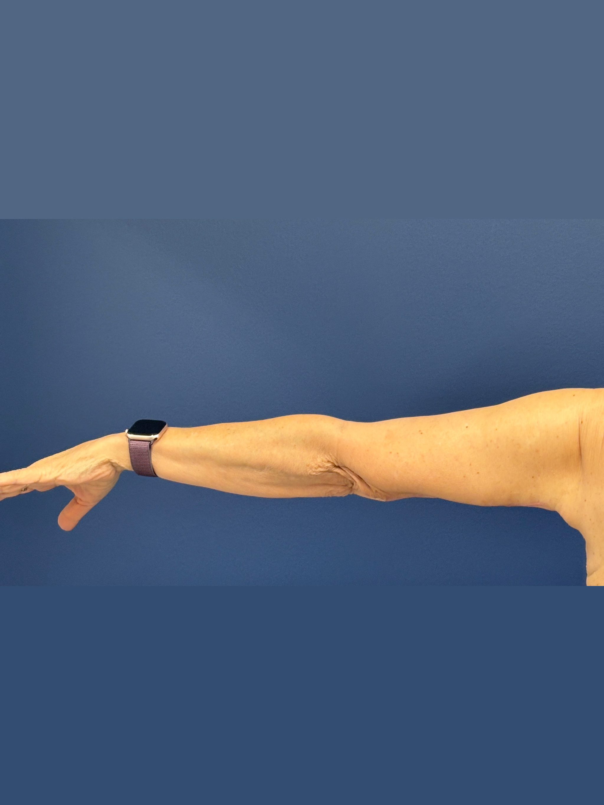 Brachioplasty-Case--3625 | After Arm Lift 8