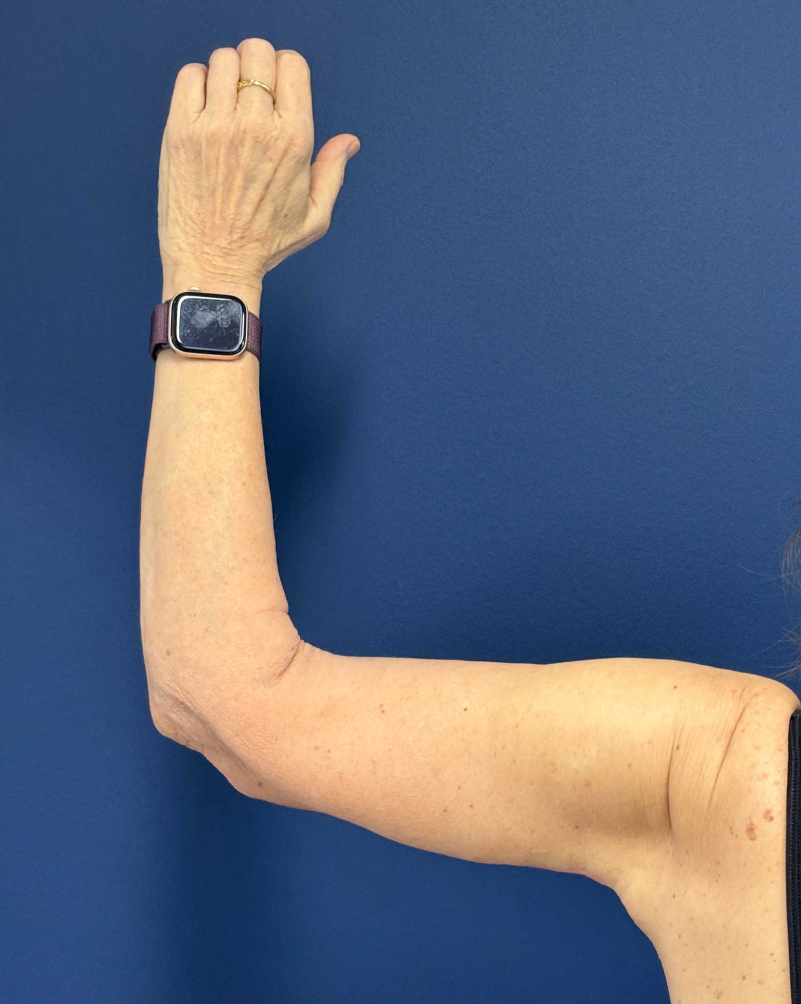 Brachioplasty-Case--3625 | After Arm Lift 4