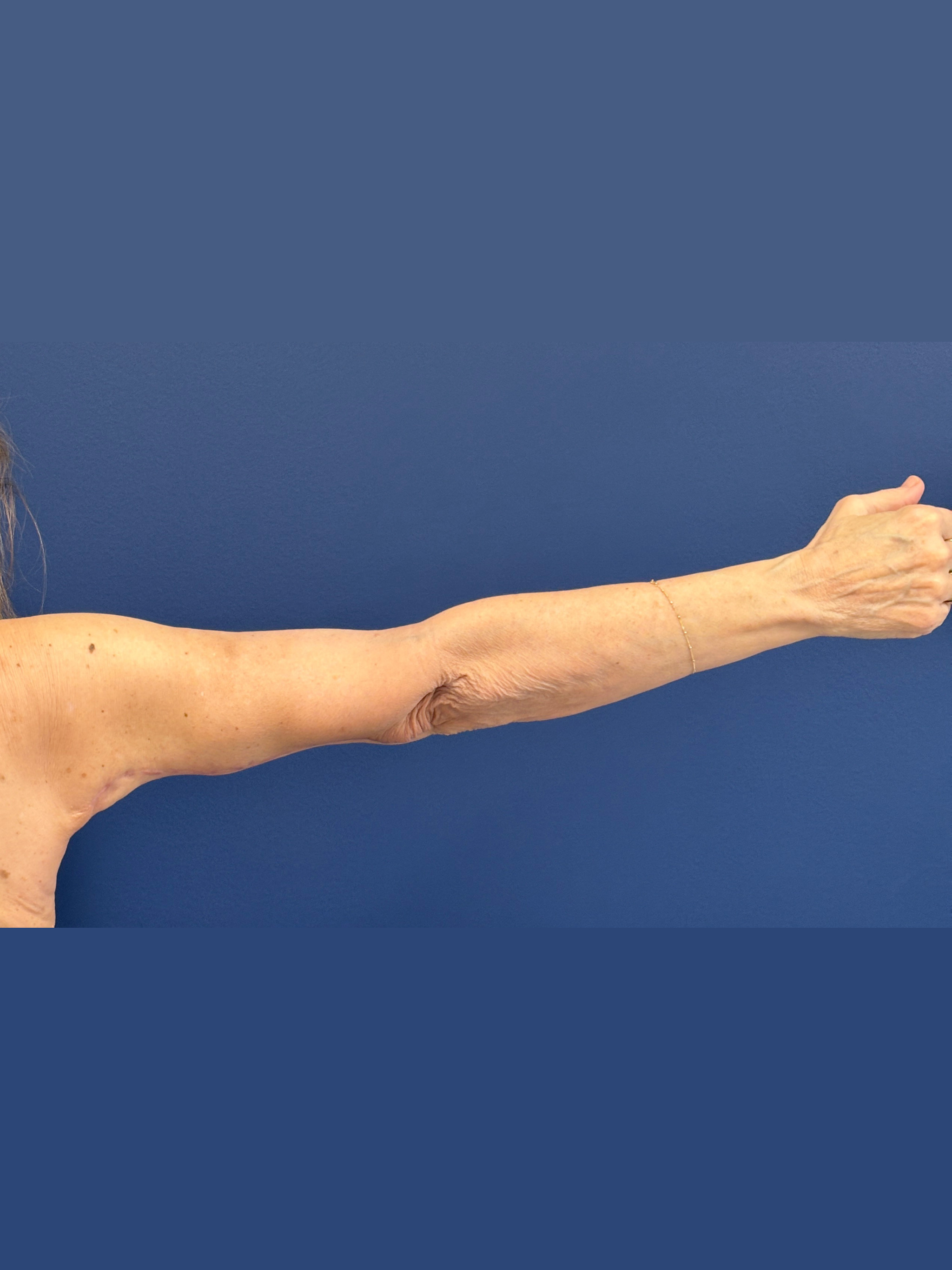 Brachioplasty-Case--3625 | After Arm Lift 7