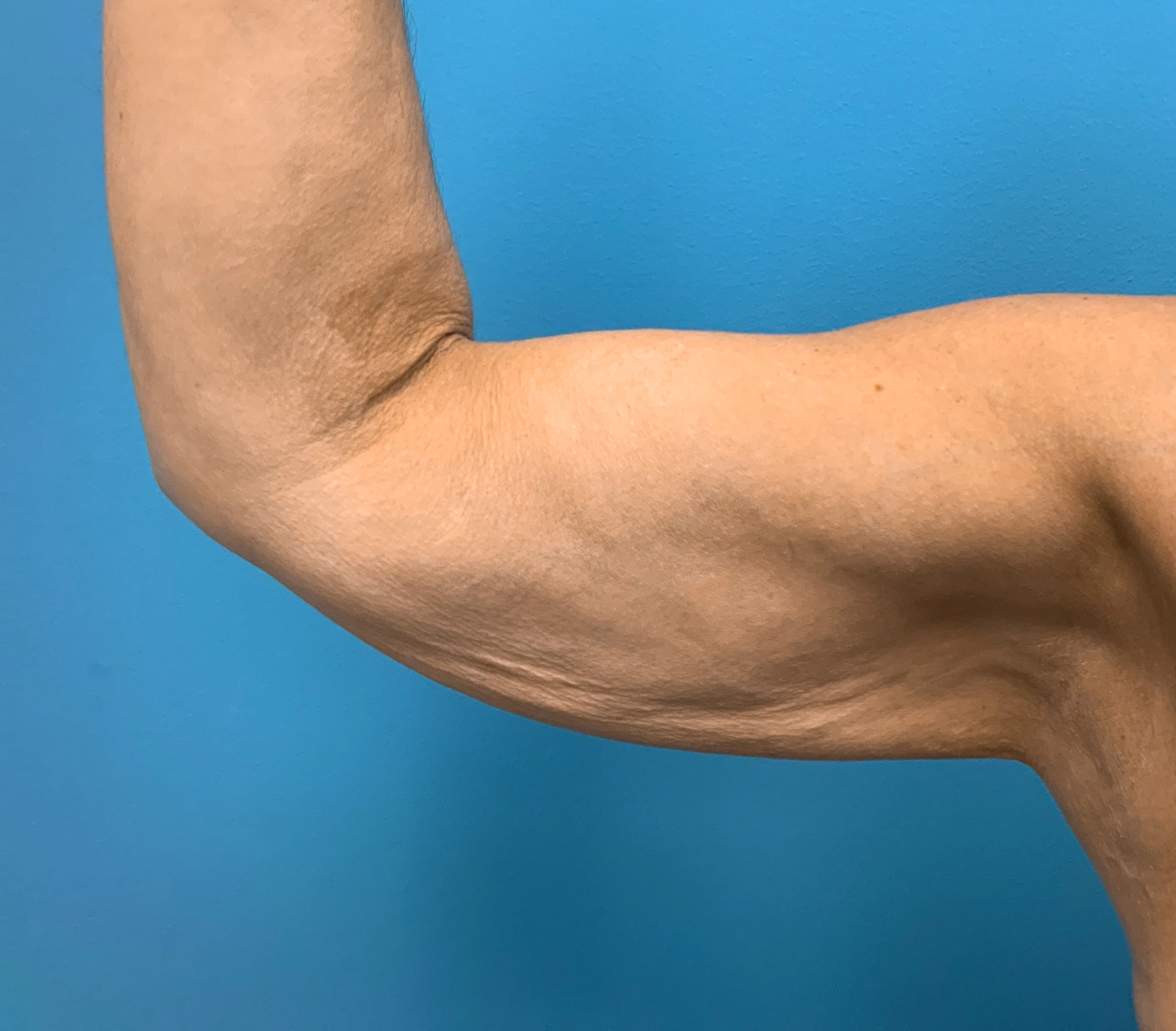 Brachioplasty-Case--2564 | Before Arm Lift 4