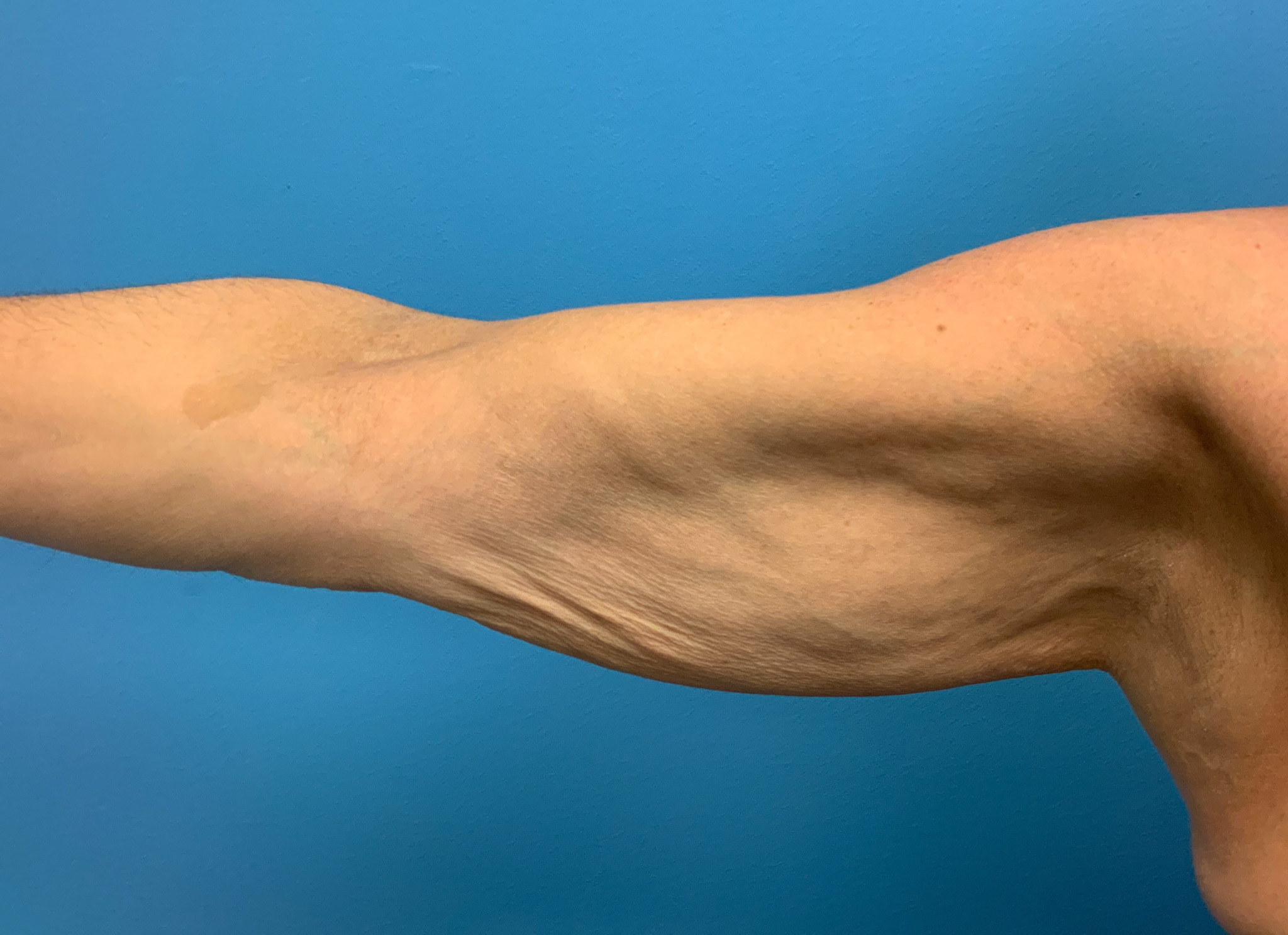 Brachioplasty-Case--2564 | Before Arm Lift 2