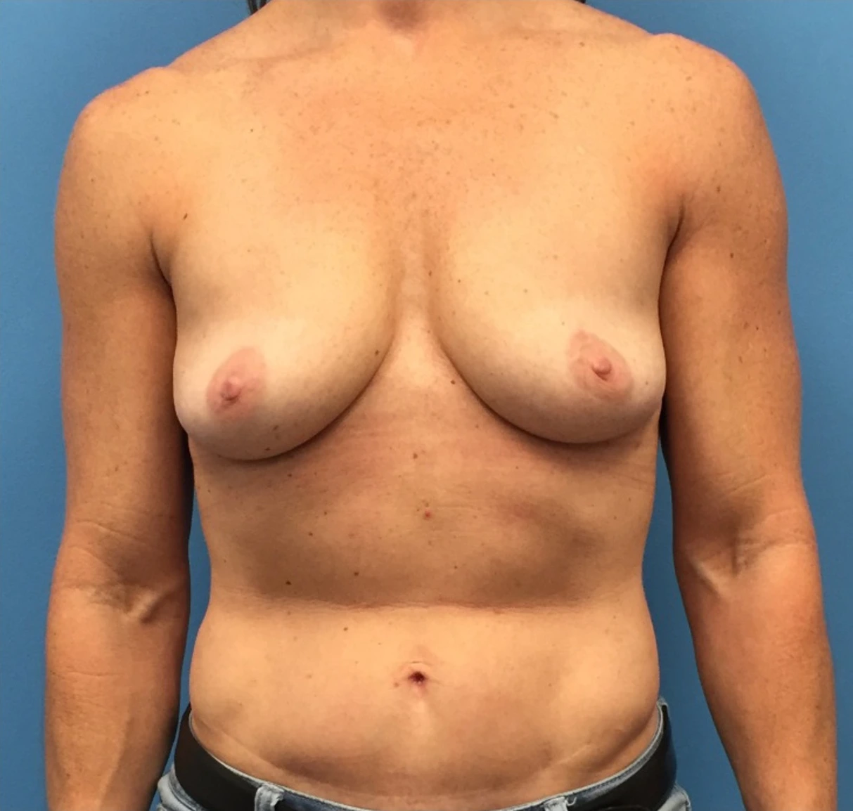 Breast-Augmentation-Mastopexy-Case--230 | Before Dr. Samir Rao 1