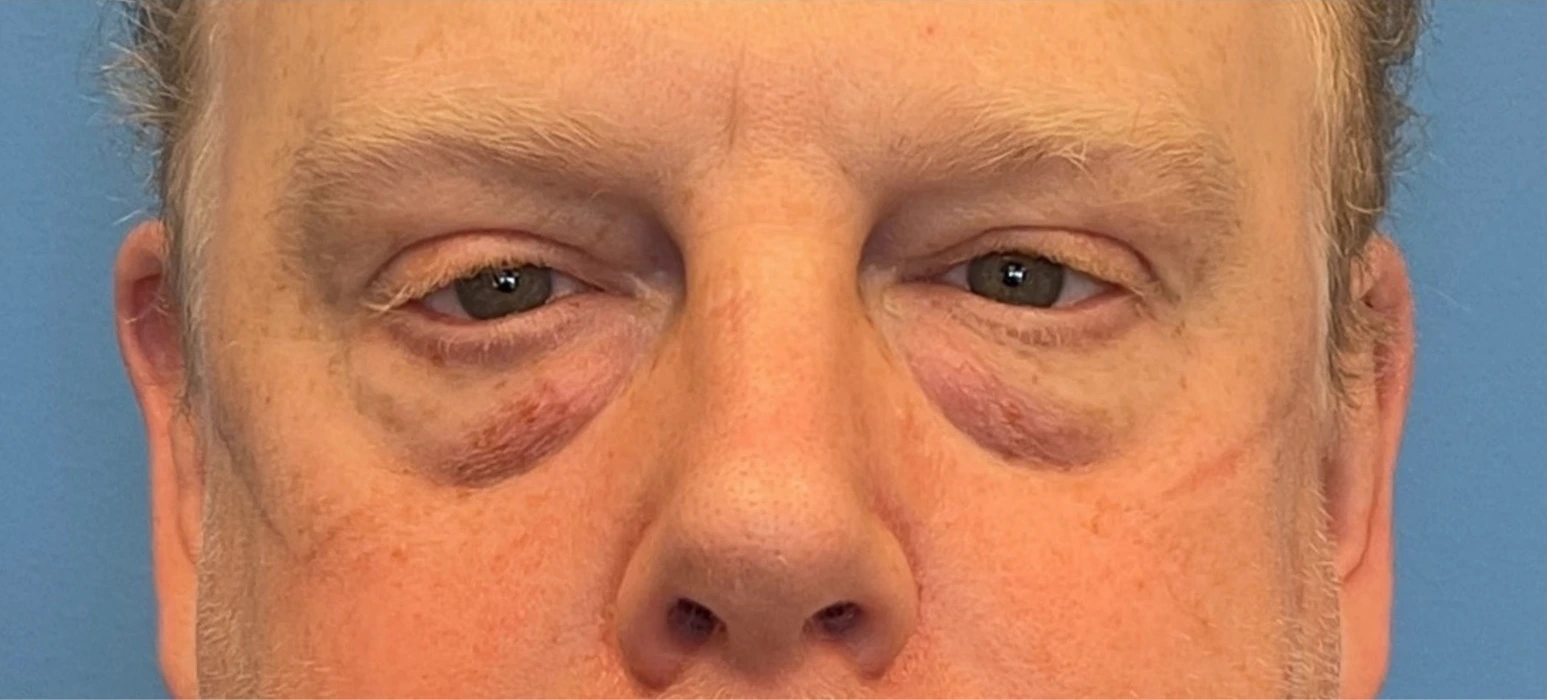 Lower-Blepharoplasty-Case--289 | Before Dr. Samir Rao 1