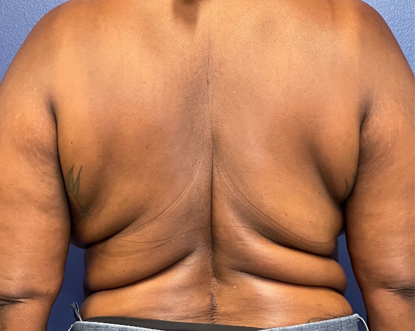 Body-Lift-Case--275 | Before Body 1