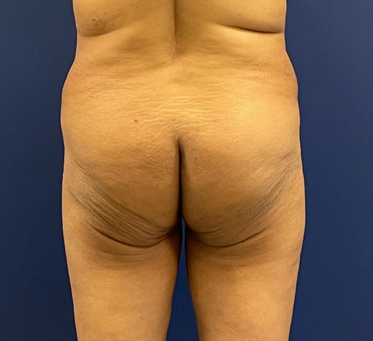 Brazilian-Butt-Lift-Case--215 | Before Brazilian Butt Lift 1