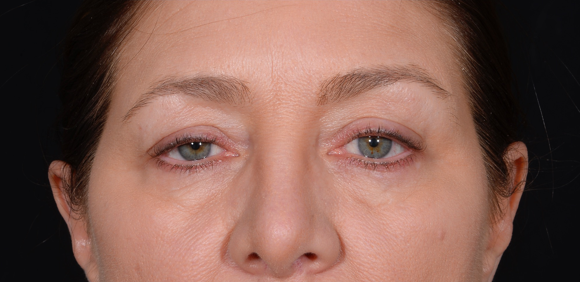 Quad-Blepharoplasty-Case--358 | Before Face 2